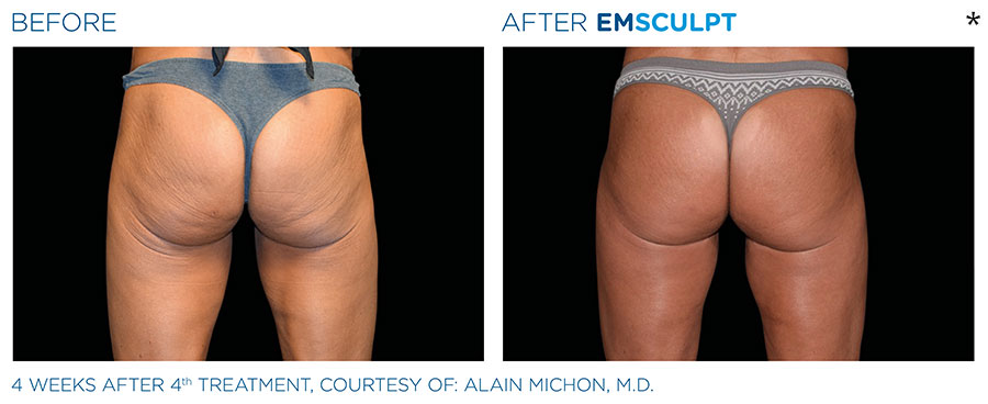 Before and After Photo of Butt Lift Treatment in San Francisco